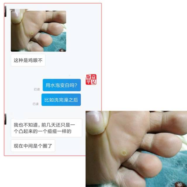 宝妈们注意了, 孩子脚上这些不是鸡眼, 不要盲目用鸡眼贴