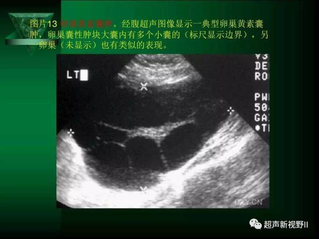 【超声微课堂】阴道超声检查规范