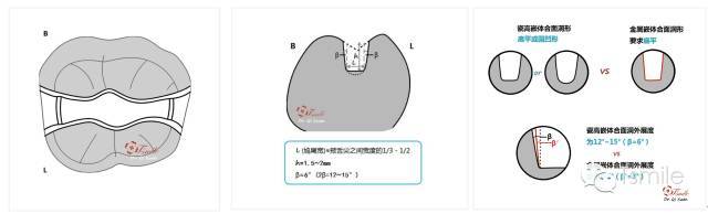 瓷嵌体合面洞不预备洞缘斜面(cavosurface bevel,这点和金合金嵌体不