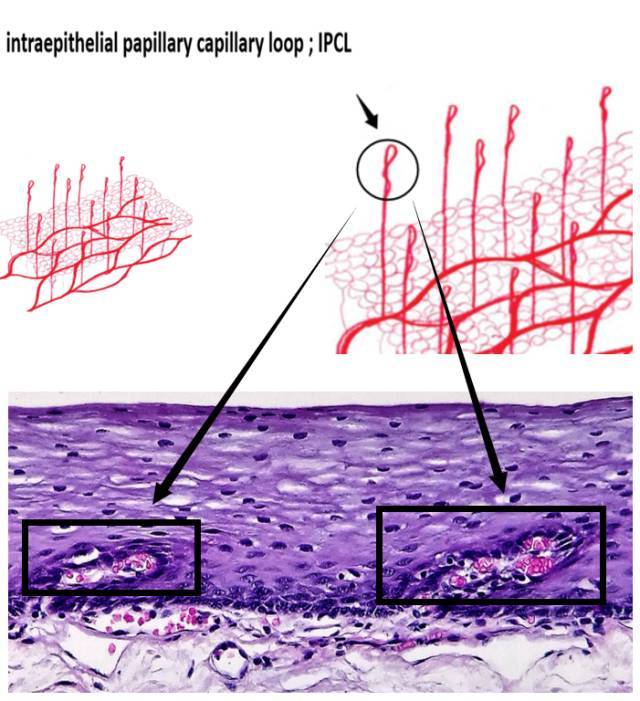 图13 1.上皮乳头内毛细血管袢:ipcl(图14)