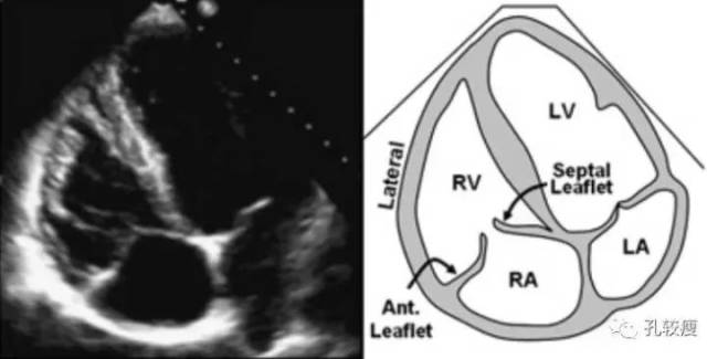 心尖四腔心切面:主要用于显示右心室侧壁