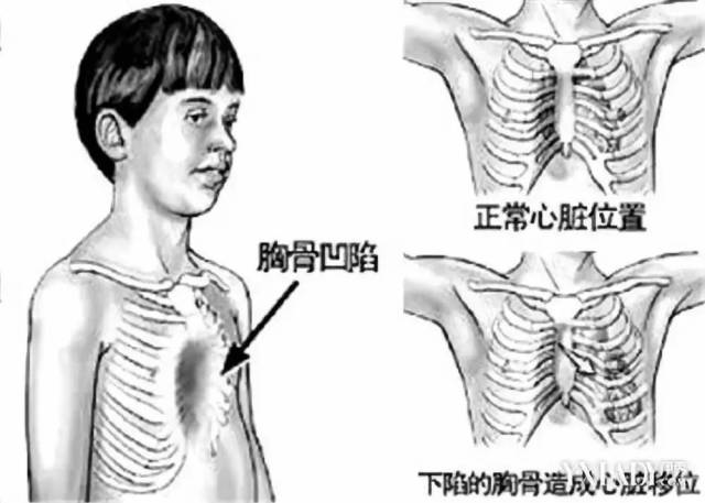 胸腔镜辅助下漏斗胸矫形nuss手术 | 为患者解决烦扰5年的"胸壁凹陷"