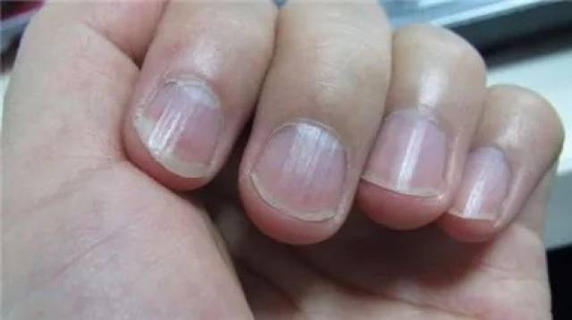 是维生素a),缺乏钙离子,或消化功能出现异常等都会造成指甲出现竖纹