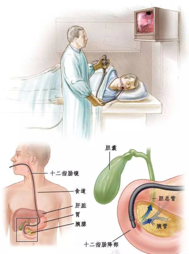 王雁医师表示,ercp技术(经内镜下逆行胰胆管造影)是在消化内镜检查