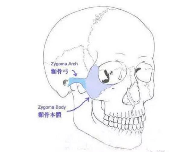 看一下颧骨颧弓改善后的案例,明显就年轻圆润许多.