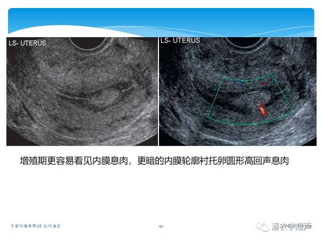 【超声微课堂】子宫内膜异常的超声诊断:子宫内膜息肉