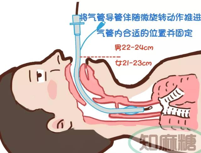 气管插管操作完成.