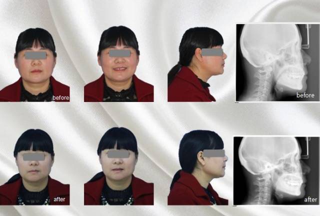 显示无进一步牙槽骨吸收,正畸前后面像对比以及患者正畸前后头颅侧位
