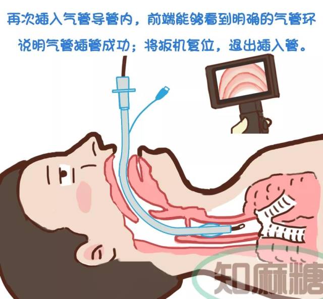 7 插管第五步--确认,撤退 tip:为确定气管插管是否成功,操作者用右手