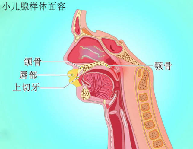 腺样体面容,是指由于腺样体肥大导致面骨发育障碍,颌骨变长,腭骨高拱