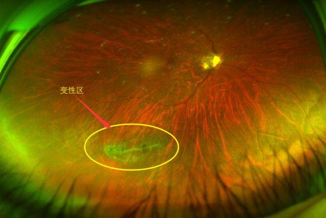 如图 下图:高度近视导致的视网膜裂孔 上图:视网膜激光光凝术后形成的