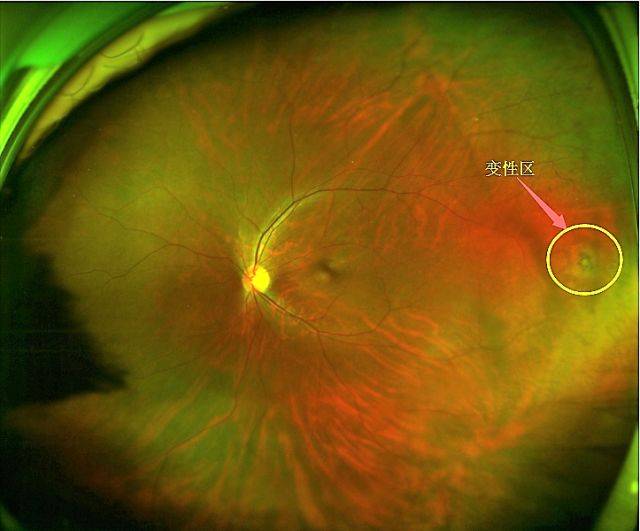下图:正常人眼底 上图:近视眼眼底 高度近视会导致视网膜裂孔,视网膜