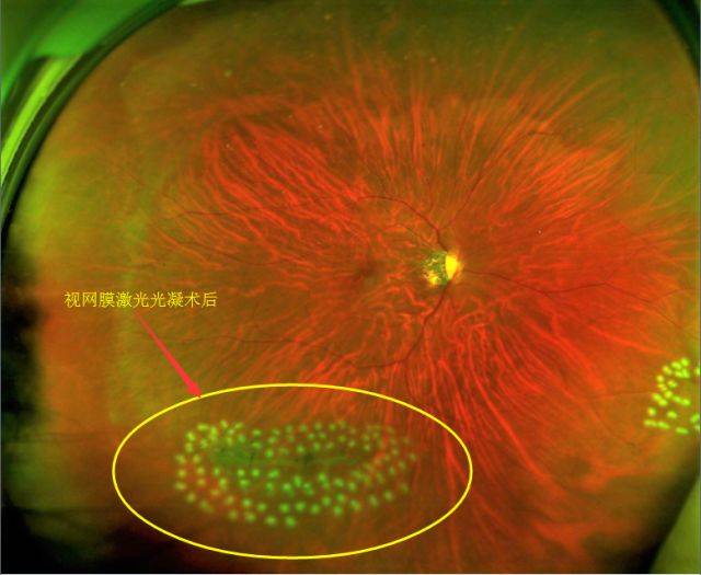 如图 下图:高度近视导致的视网膜裂孔 上图:视网膜激光光凝术后形成的
