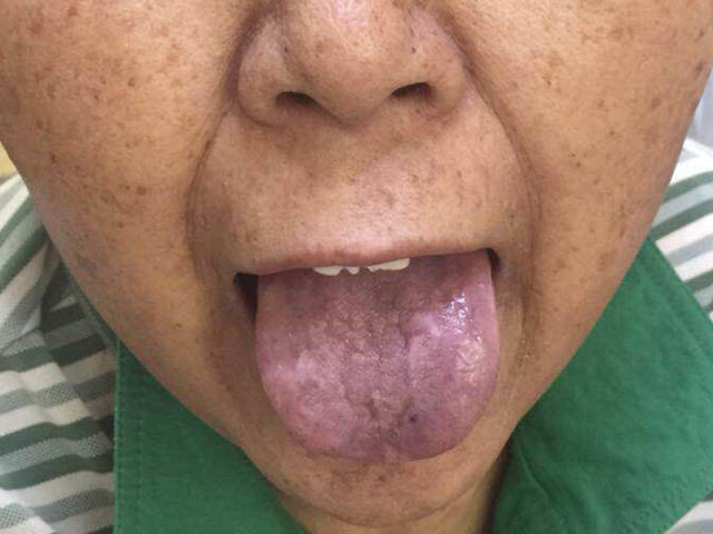 三张舌象对比照,二十八年抗癌人