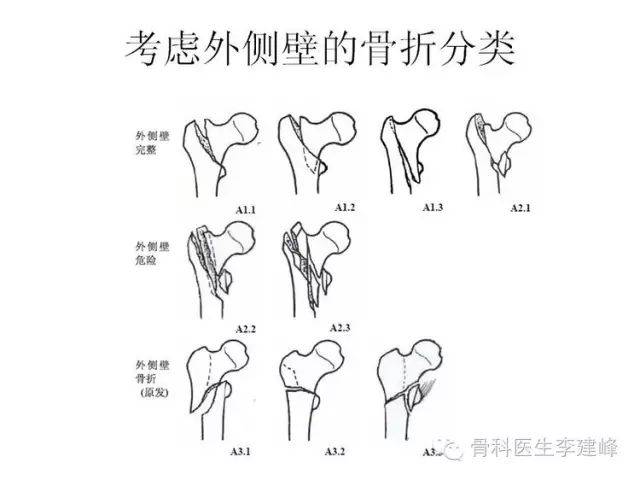 股骨粗隆间骨折内固定治疗进展