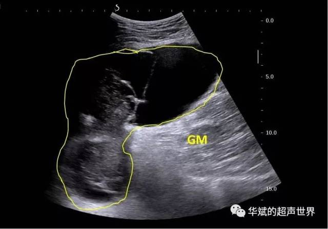 病灶位于臀大肌(gm)浅方,并通过一形似窦道的区域进入肌肉深方