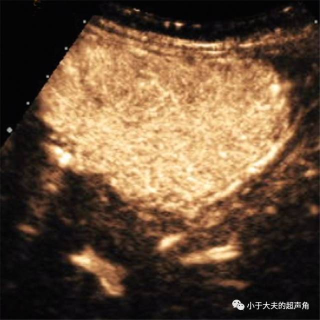 [超声易识记]肝细胞腺瘤 hepatic adenoma