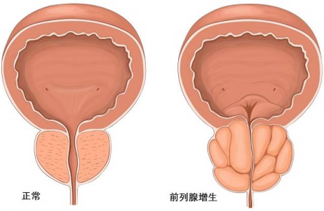 病变后的前列腺,比正常的肥大,就会挤压尿道,使尿道逐渐变得狭窄.