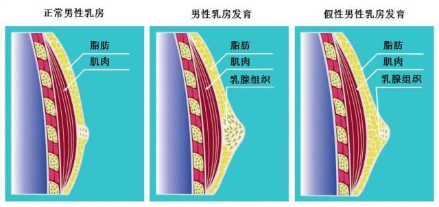 雌激素过多,雄激素不足,一些疾病和药物……都可能导致男人胸部发育.