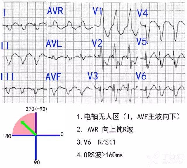 即使是房室分离也有可能是室上速并差传(因为他没有侵入窦房结重整