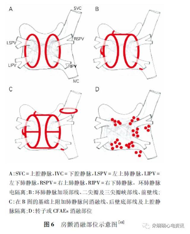 心房颤动: 目前的认识和治疗的建议--2018 (三)