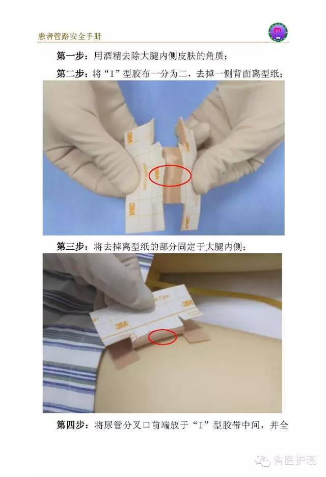 导尿管老是滑脱,你可以试试这种方法