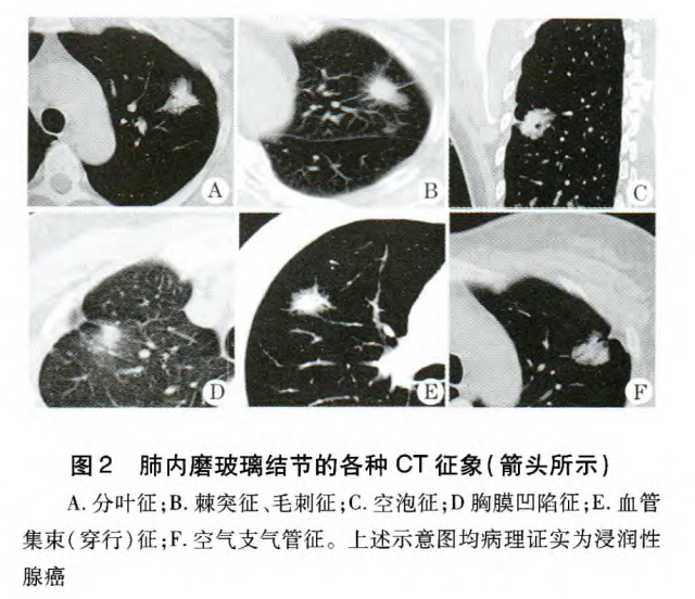 肺癌与ggn(肺部磨玻璃结节)之间那些不得不说的事儿