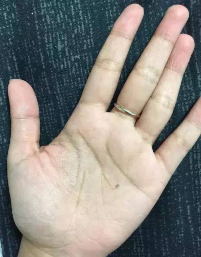 痣相:手掌的痣代表什么