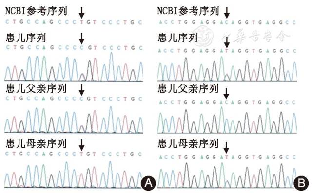 【病例报告】lamc3基因复合杂合突变的婴儿痉挛症一例