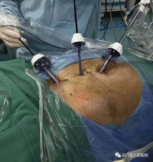 腹壁疝(包块脐疝,白线疝,切口疝,腰疝等)患者,传统手术需较大手术切口