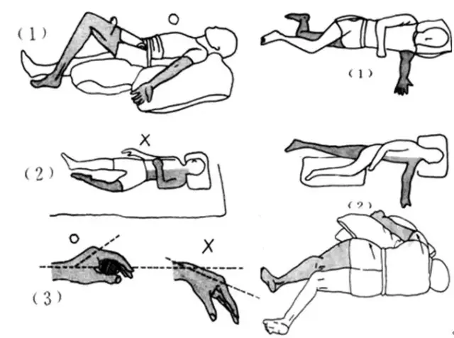 脑卒中患者肢体瘫痪护理姿势