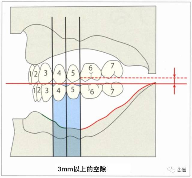 按照gerber method基本的人工牙排列方法-杵臼禾的原点及其最新的论述