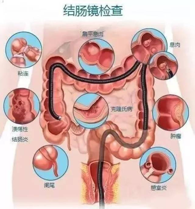 健康|肠镜报告上的结肠多发息肉是什么意思?