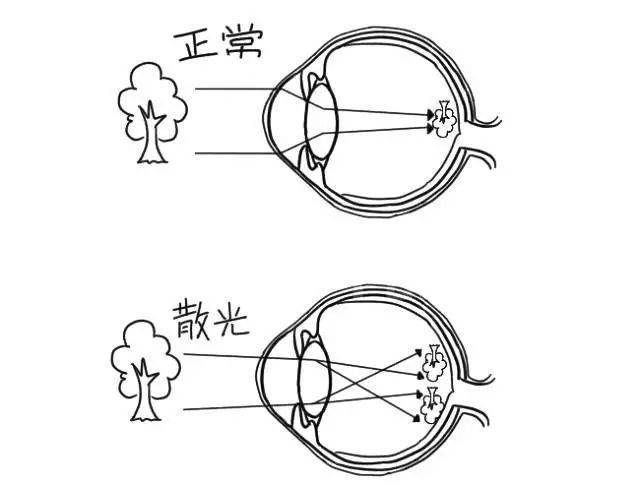 首大王宇几张图带你走进近视远视散光的世界