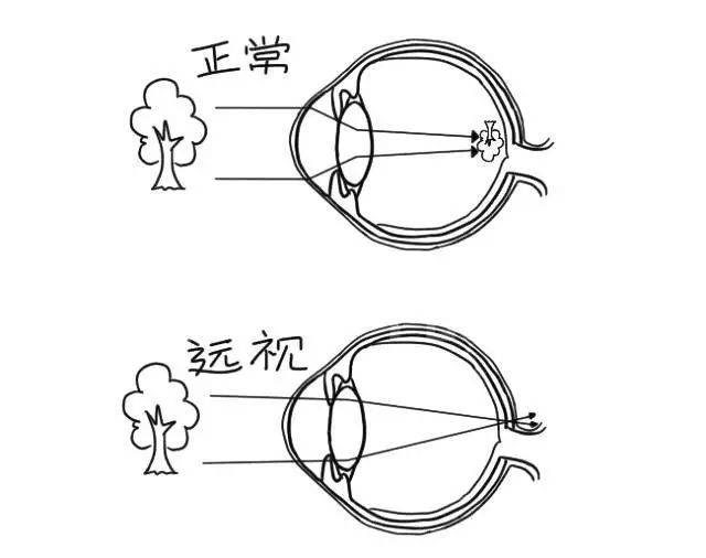 远视 ▼ 远视是人眼看到的物体成像在视网膜的后方.