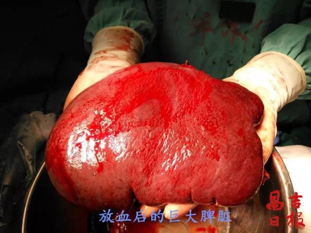 昌吉一男子脾大如西瓜 州医院医生10小时手术切除