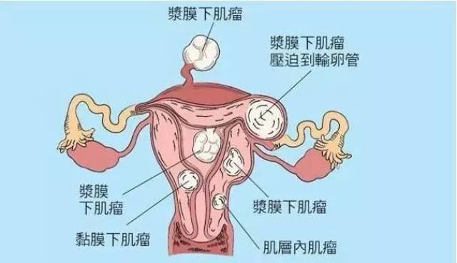 越来越多人患上子宫肌瘤,影响到底有多大?