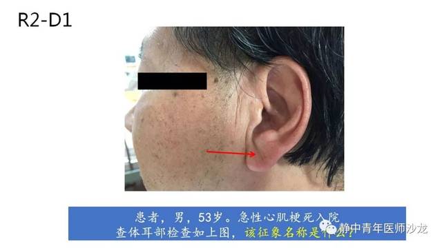 答案:frank征