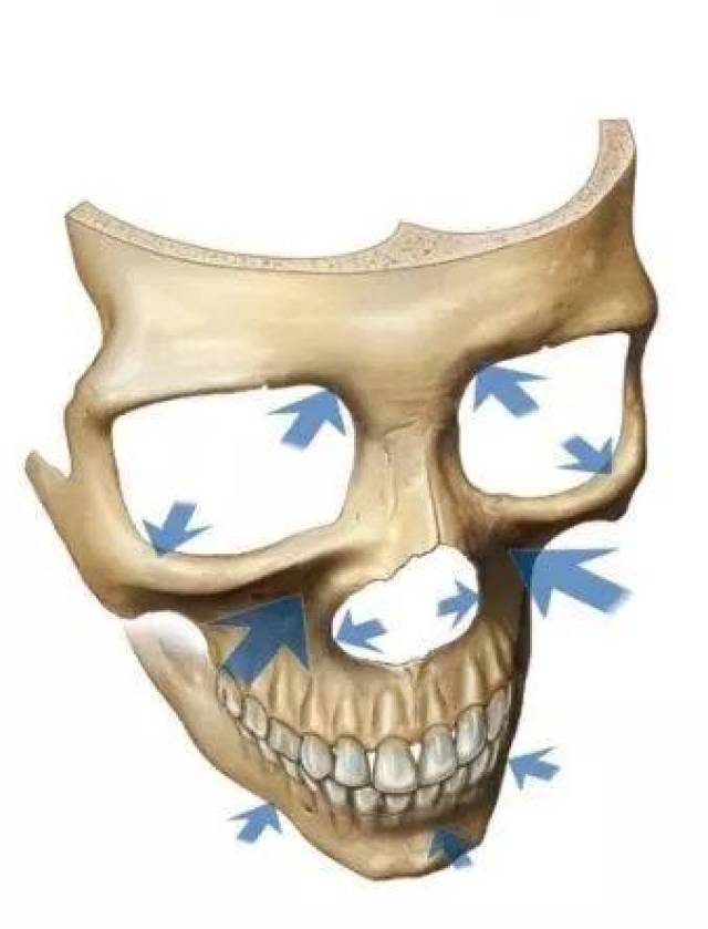骨骼层次:颅颌面骨骼容积减少,外下眶缘向外下移行,上颌骨向后移行