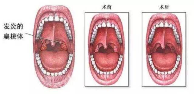 6. 其他扁桃体疾病,扁桃体角化症及良性肿瘤.