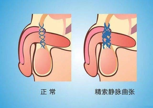 2.隐睾