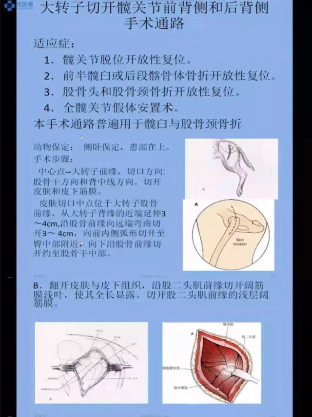 骨盆手术通路详细分解,髋关节诊疗,请收下这份课程精华总结!