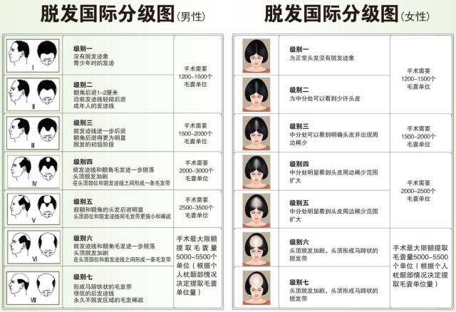 脱发等级该如何判定?看看自己到了第几级了?