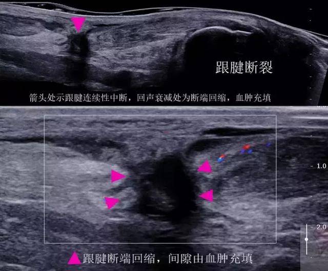 2)跟腱部分撕裂