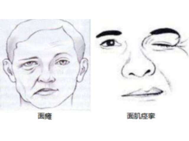 【症状鉴别】如何症状区别面肌痉挛和面瘫?