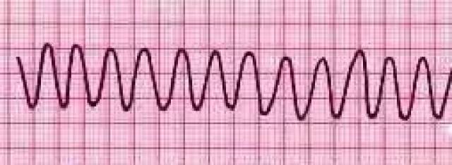 出现大小,形态,距离不等的室颤波,频率250-500次/分;此为