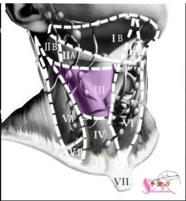 Ⅲ区 level 为颈内静脉淋巴结中区,从舌骨水平至肩胛舌骨肌与颈
