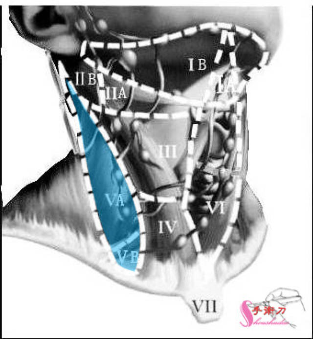 颈部淋巴结分区法示意图
