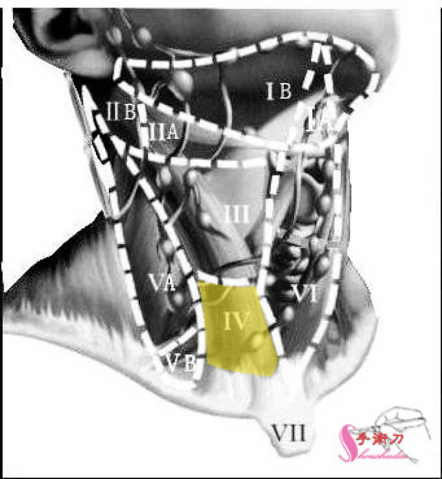 颈部淋巴结分区法示意图