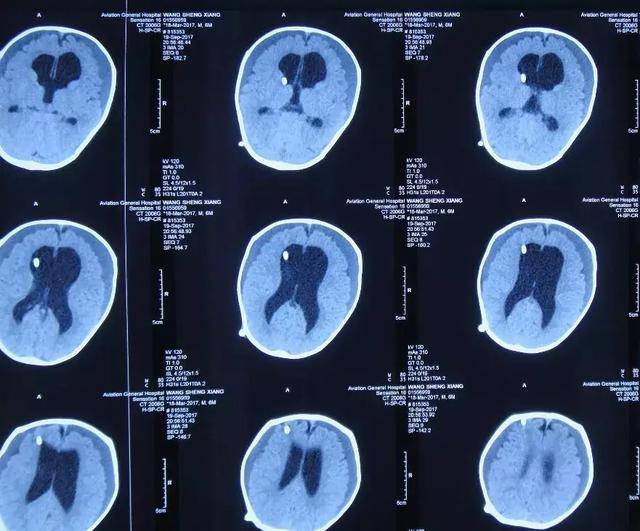 三个月婴儿脑膜炎脑积水 ommaya囊置入术失败致颅内感染 现在宝宝竟变